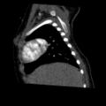 Aberrant left pulmonary artery (pulmonary sling) (Radiopaedia 42323-45435 Sagittal C+ arterial phase 10).jpg