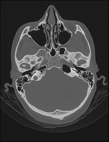 File:Aberrant right internal carotid artery (Radiopaedia 65191-74198 Axial non-contrast 39).jpg