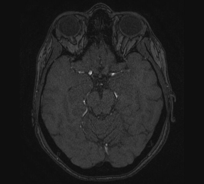 File:Accessory middle cerebral artery and ICA aneurysm (Radiopaedia 22656-22674 MRA 44).jpg