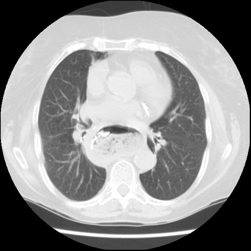 Achalasia (Radiopaedia 44094-47649 Axial lung window 32).jpg
