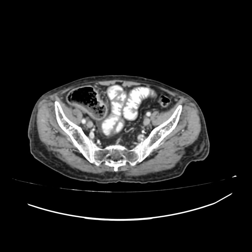 Acute-on-chronic Crohn disease with enteroenteric fistula (Radiopaedia 66686-75987 B 58).jpg