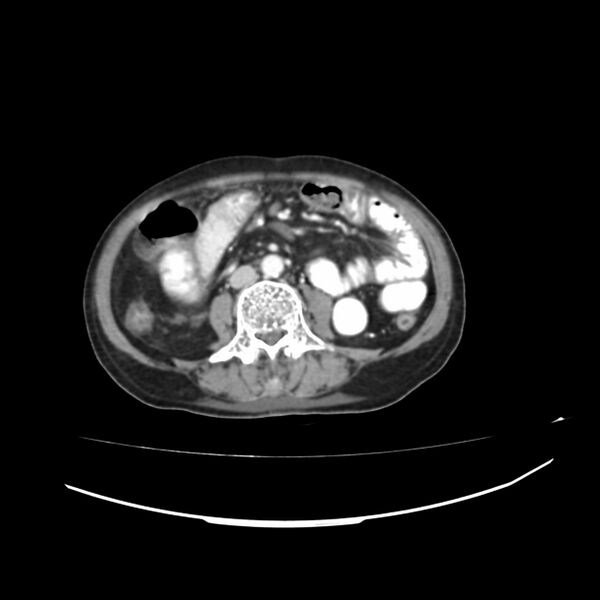 File:Acute-on-chronic Crohn disease with enteroenteric fistula (Radiopaedia 66686-75987 B 6).jpg