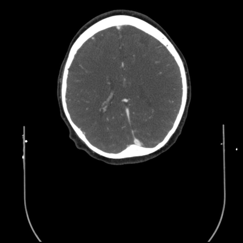 Acute M1 occlusion with ischemic penumbra (CT perfusion) (Radiopaedia 71897-82344 Axial C+ arterial phase thins 19).jpg