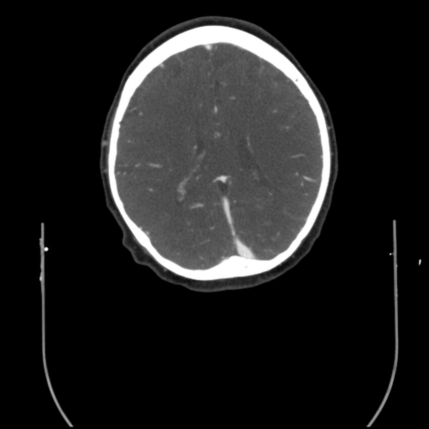 Acute M1 occlusion with ischemic penumbra (CT perfusion) (Radiopaedia 71897-82344 Axial C+ arterial phase thins 23).jpg
