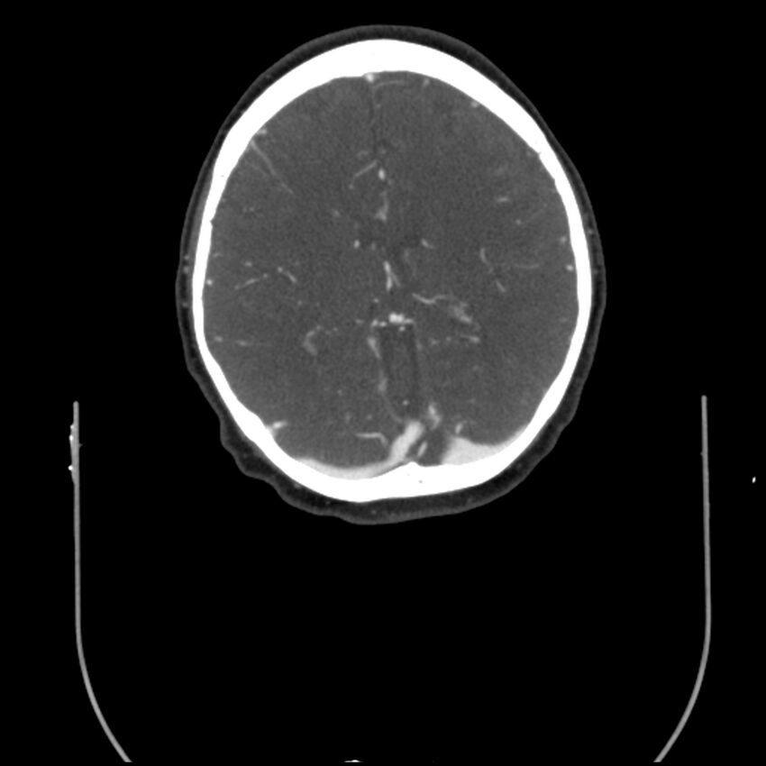 Acute M1 occlusion with ischemic penumbra (CT perfusion) (Radiopaedia 71897-82344 Axial C+ arterial phase thins 35).jpg