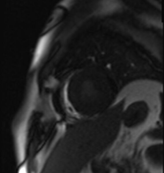 File:Acute anteroseptal myocardial infarction (Radiopaedia 68409-77945 Short axis (mid ventricular) Perfusion 7).jpg