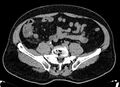 Acute appendicitis (Radiopaedia 13030-13091 Axial non-contrast 15).jpg