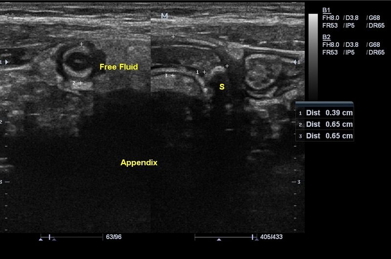 File:Acute appendicitis with appendicolith (Radiopaedia 24611).JPG
