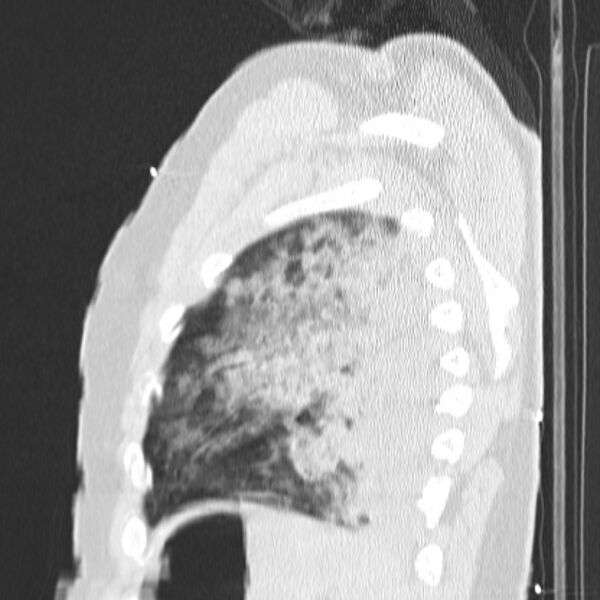 File:Acute aspiration pneumonitis (Radiopaedia 33605-34703 Sagittal lung window 72).jpg