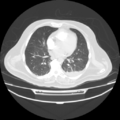 Acute heart failure (CT) (Radiopaedia 79835-93075 Axial lung window 27).png