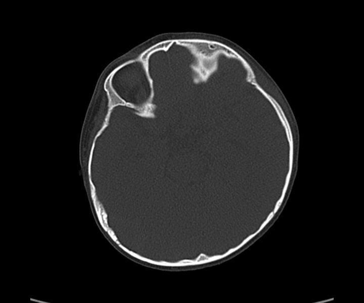 File:Acute hemorrhagic contusion (Radiopaedia 63660-72336 Axial bone window 26).jpg