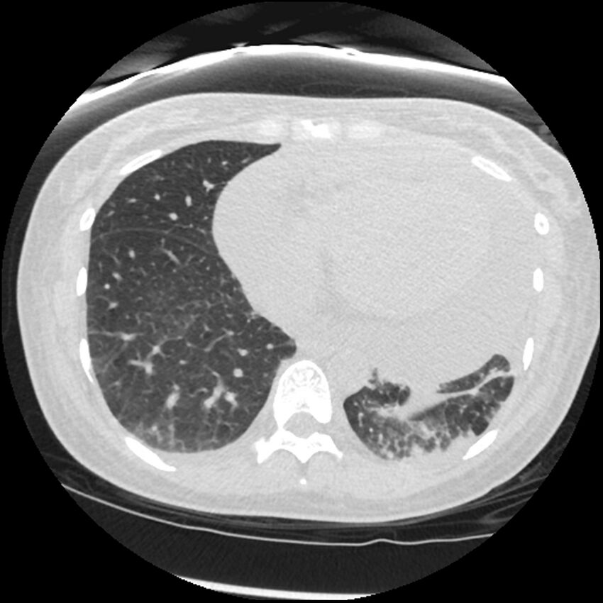 Acute lupus nephritis (Radiopaedia 45832-50107 Axial lung window 70).jpg