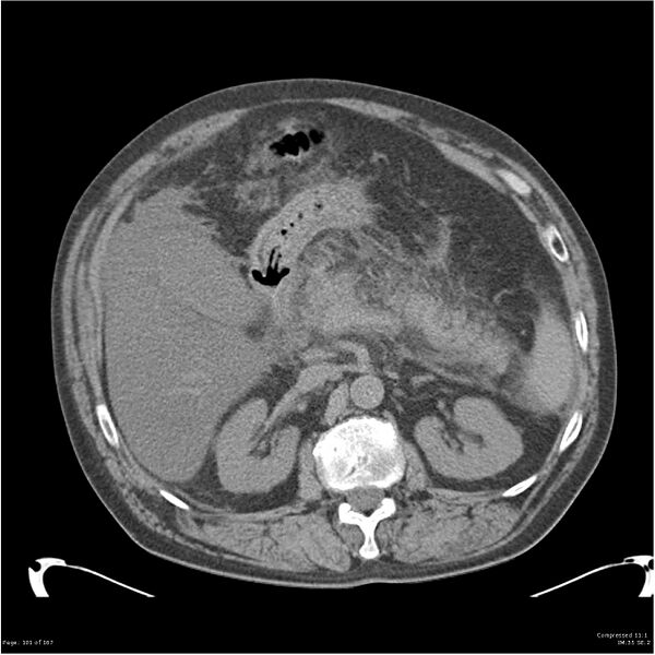 File:Acute pancreatitis (Radiopaedia 19135-19116 Axial non-contrast 15).jpg