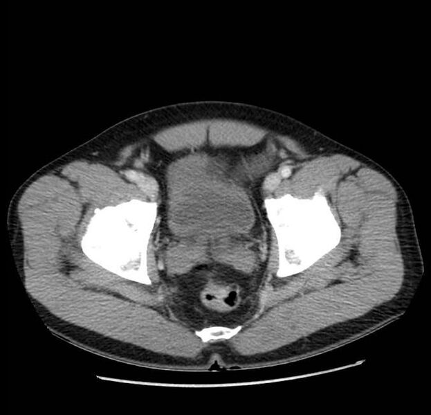 File:Acute pancreatitis - Balthazar E (Radiopaedia 23080-23110 Axial C+ portal venous phase 67).jpg