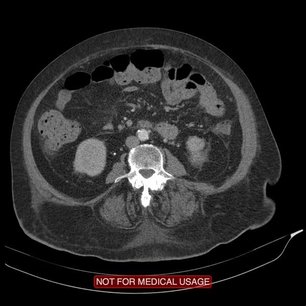 File:Acute pancreatitis with infected necrosis (Radiopaedia 26454-26585 Axial C+ arterial phase 16).jpg