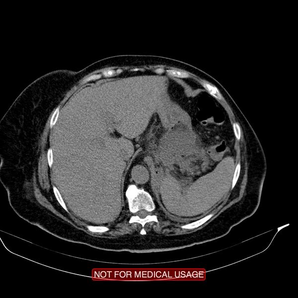 File:Acute pancreatitis with infected necrosis (Radiopaedia 26454-26585 Axial non-contrast 3).jpg