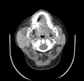 Acute parotitis (Radiopaedia 27425-27619 Axial C+ portal venous phase 22).png