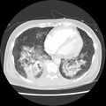 Acute pulmonary edema on CT (Radiopaedia 33582-34672 Axial lung window 37).jpg
