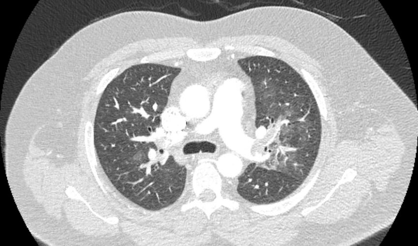 Acute pulmonary embolism with pulmonary infarcts (Radiopaedia 77688-89908 Axial lung window 40).jpg