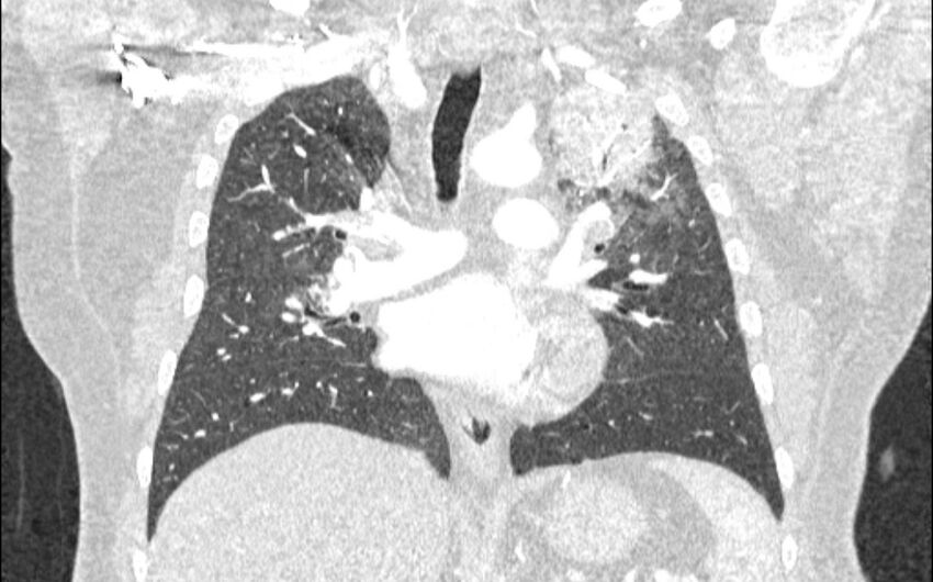 Acute pulmonary embolism with pulmonary infarcts (Radiopaedia 77688-89908 Coronal lung window 49).jpg