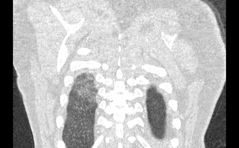 File:Acute pulmonary embolism with pulmonary infarcts (Radiopaedia 77688-89908 Coronal lung window 99).jpg