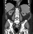 Acute renal failure post IV contrast injection- CT findings (Radiopaedia 47815-52557 Coronal non-contrast 32).jpg