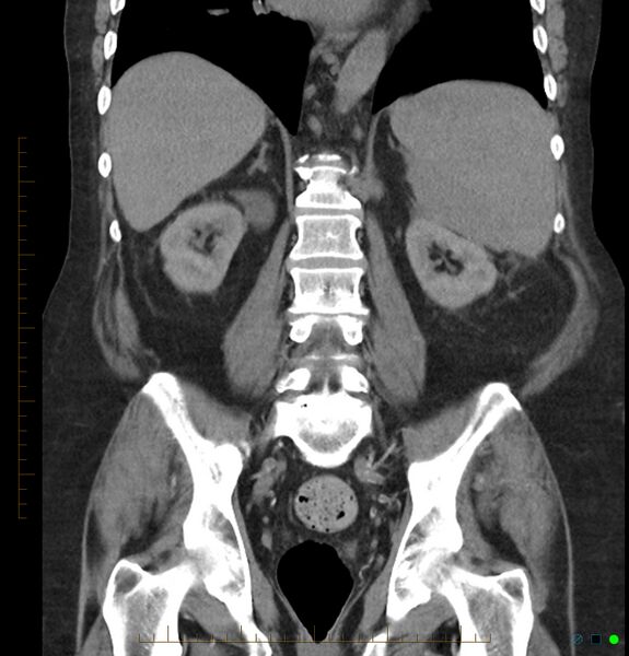 File:Acute renal failure post IV contrast injection- CT findings (Radiopaedia 47815-52557 Coronal non-contrast 32).jpg