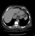 Acute renal failure post IV contrast injection- CT findings (Radiopaedia 47815-52559 Axial C+ portal venous phase 10).jpg