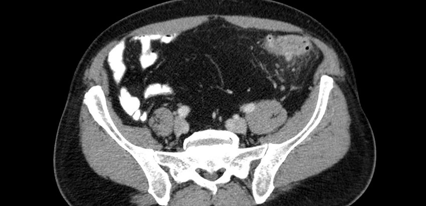 Acute sigmoid colon diverticulitis (Radiopaedia 55507-61976 Axial C+ portal venous phase 69).jpg