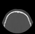Acute sinusitis (Radiopaedia 23161-23215 Axial bone window 82).jpg