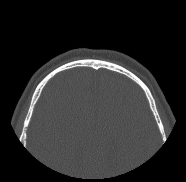 File:Acute sinusitis (Radiopaedia 23161-23215 Axial bone window 82).jpg