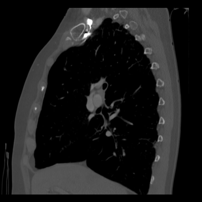Adenocarcinoma of the lung (Radiopaedia 41015-43755 Sagittal bone window 39).jpg