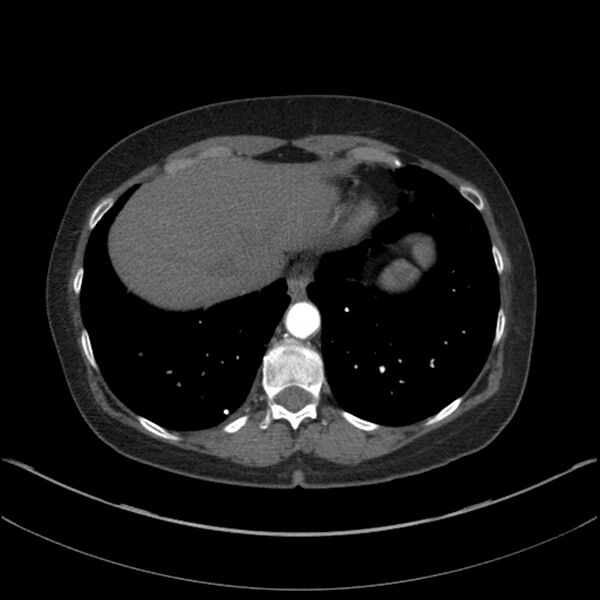 File:Adenocarcinoma of the lung (Radiopaedia 44205-47803 Axial C+ portal venous phase 69).jpg