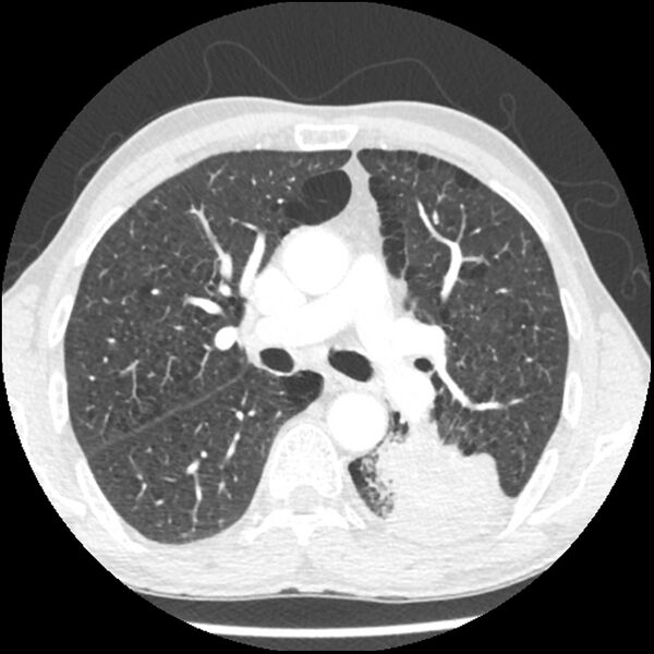 File:Adenocarcinoma of the lung - micropapillary predominant (Radiopaedia 42446-45563 C 30).jpg