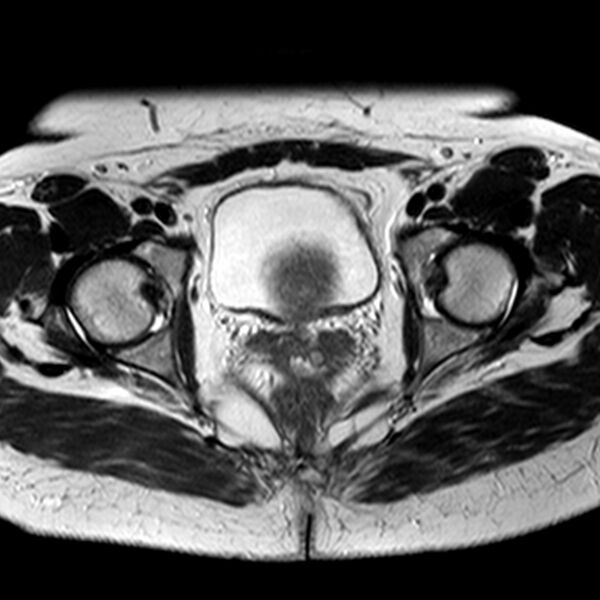 File:Adenomyoma of the uterus (Radiopaedia 9871-10439 Axial T2 11).jpg
