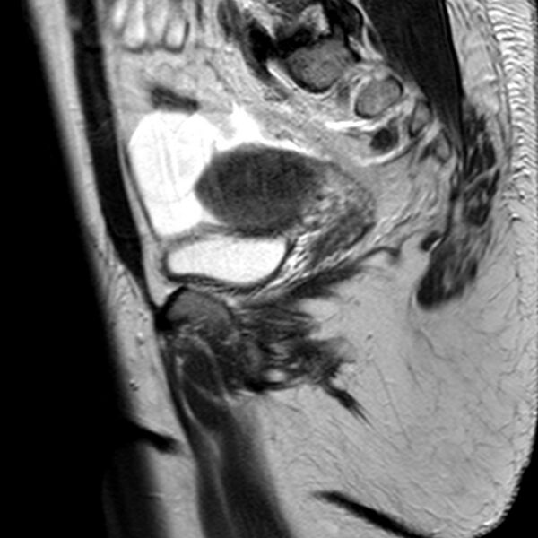 File:Adenomyoma of the uterus (Radiopaedia 9871-10439 Sagittal T2 9).jpg