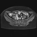 Adenomyosis and endometriotic cysts (Radiopaedia 82300-96367 Axial T1 C+ fat sat 27).jpg