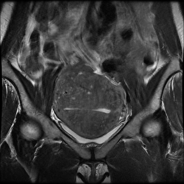 File:Adenomyosis on MRI (Radiopaedia 29328-29780 Coronal T2 11).jpg