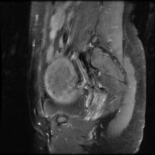 File:Adenomyosis on MRI (Radiopaedia 29328-29780 Sagittal T1 C+ fat sat 3).jpg