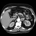 Adrenal hemangioma (Radiopaedia 11039-11445 Axial ROIs HU 2).jpg