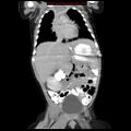 Adrenal hemorrhage (Radiopaedia 9390-10077 Coronal C+ portal venous phase 3).jpg