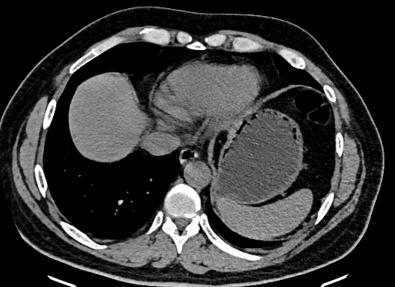 File:Adrenal metastases (Radiopaedia 73082-83791 Axial non-contrast 16).jpg