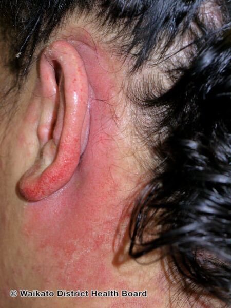 File:Allergic contact dermatitis to hair dye (DermNet NZ contact-dermatitis-024).jpg
