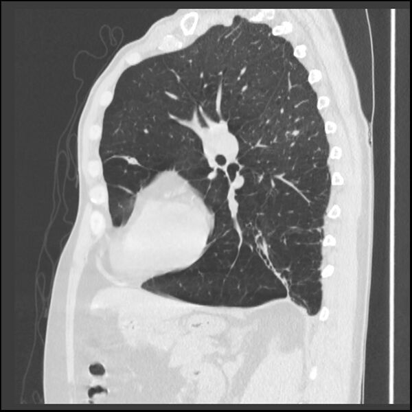 File:Alpha-1-antitrypsin deficiency (Radiopaedia 40993-43722 Sagittal lung window 103).jpg