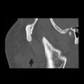 Ameloblastic fibro-odontoma (Radiopaedia 18843-18780 bone window 16).jpg