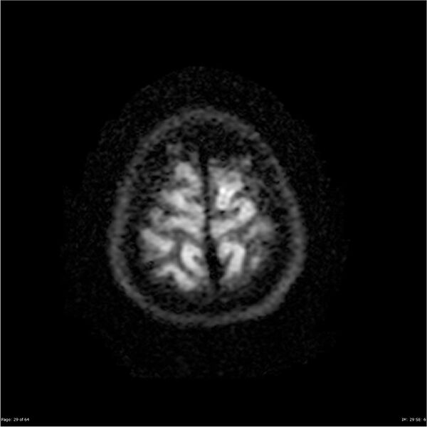 File:Amnestic syndrome secondary to hypoxic brain injury (Radiopaedia 24743-25004 DWI 29).jpg