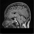 Amnestic syndrome secondary to hypoxic brain injury (Radiopaedia 24743-25004 D 8).jpg