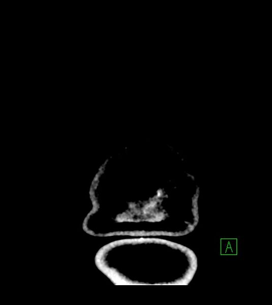 File:Anaplastic oligodendroglioma (Radiopaedia 79571-92753 Coronal non-contrast 73).jpg