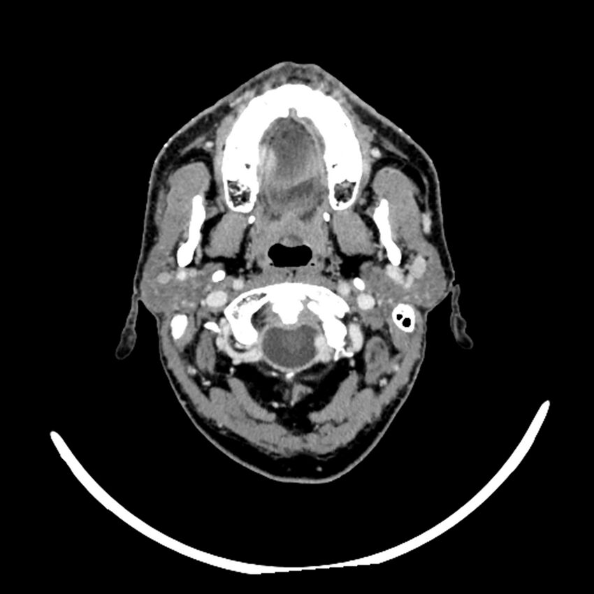 Anaplastic thyroid carcinoma (Radiopaedia 79087-92034 B 104).jpg