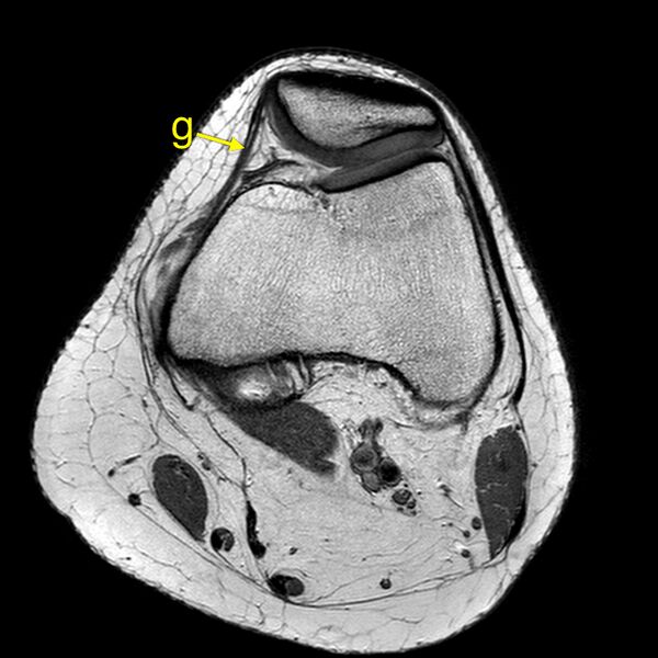 File:Anatomy Quiz (MRI knee) (Radiopaedia 43478-46866 A 8).jpeg